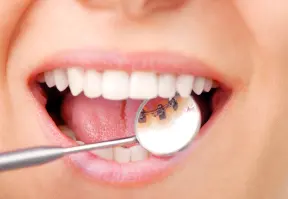 Ein strahlendes Lächeln mit einer Lingualzahnspange dank der Zahnzusatzversicherung des Münchener Vereins