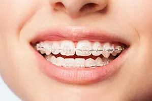 Ein strahlendes Lächeln mit Zahnspange danke der Zahnzusatzversicherung vom Münchener Verein