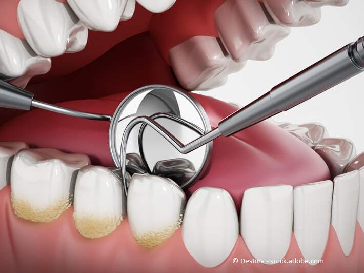 Gebiss mit Zahnbelag und Zahninstrumenten - 3D-Illustration