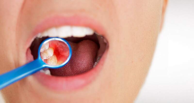 Zahnfleischentzündung und Parodontitis als mögliche Folge von Rheuma