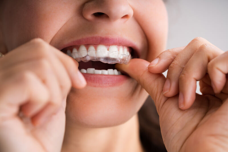 Aufbissschiene ist eine Behandlungsmöglichkeit gegen Zähneknirschen.