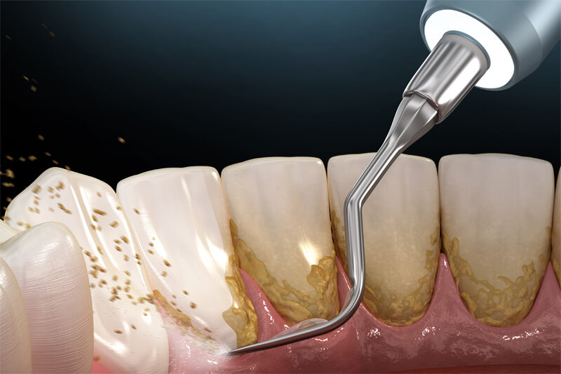 Mundhygiene: Ultraschall-Zahnreinigungsgerät zur Entfernung von Zahnstein und Plaque