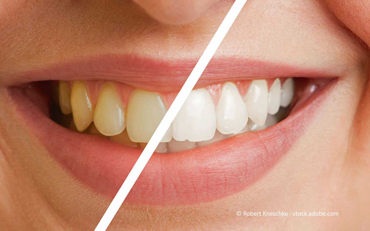Vergleich von Zähnen vor und nach einem Zahnbleaching