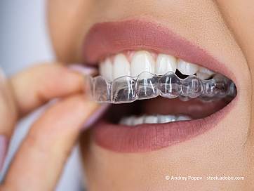 Invisalign Kosten senken: So hilft die Zahnzusatzversicherung