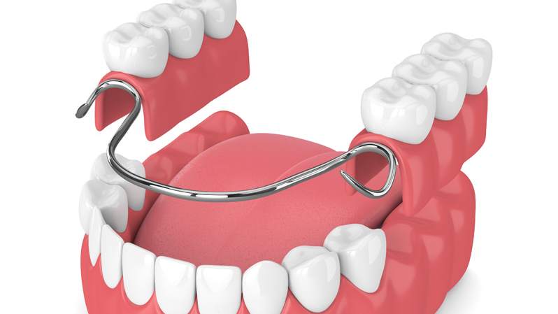 Bei einer Klammerprothese wird der Zahnersatz mit Klammern an den benachbarten Zähnen befestigt.