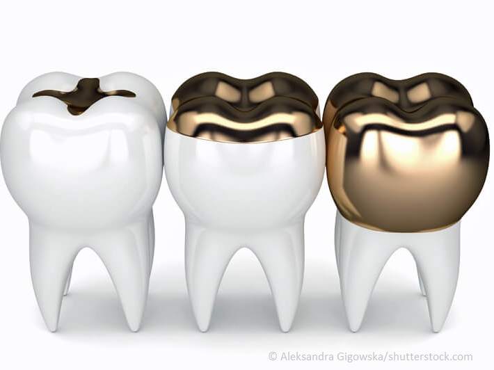 Ratgeber Zahngesundheit: 3D-Rendering von Zähnen mit Inlay, Onlay und Overlay 