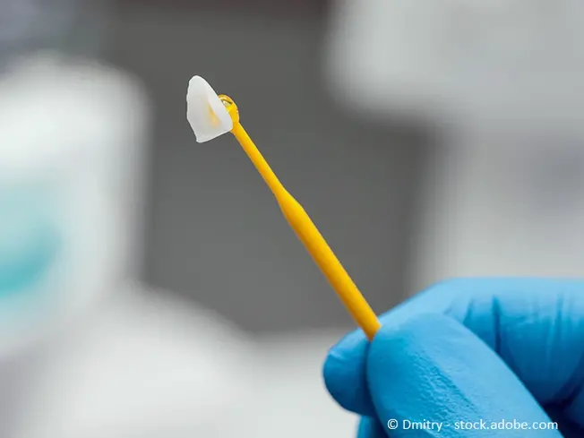 Nahaufnahme einer Keramikverblendung auf einem Stab in der Hand eines Zahnarztes