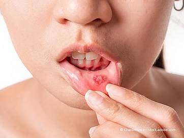 Aphten: Ursachen und Tipps bei schmerzenden Entzündungen im Mund