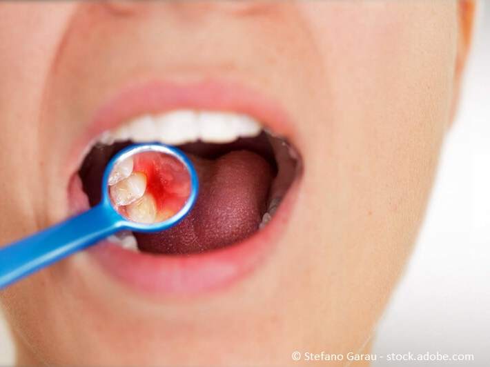 Parorodontose: Schmerzhaft entzündetes Zahnfleisch sichtbar mit Mundspiegel