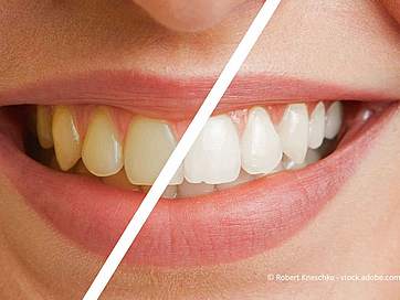 Zähne aufhellen: Zu Hause oder beim Zahnarzt? Methoden, Kosten, Risiken