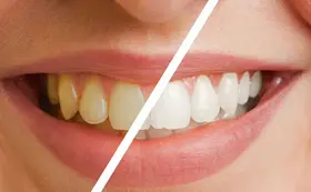 Vergleich von Zähnen vor und nach einem Zahnbleaching