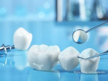 Zahnkronen im Überblick: Kosten, Ablauf, Arten & die Zahnzusatzversicherung