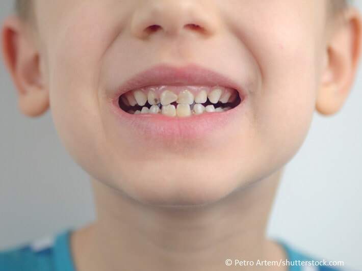 Kreidezähne -Porträt eines kleinen Jungen mit schlechten Zähnen 