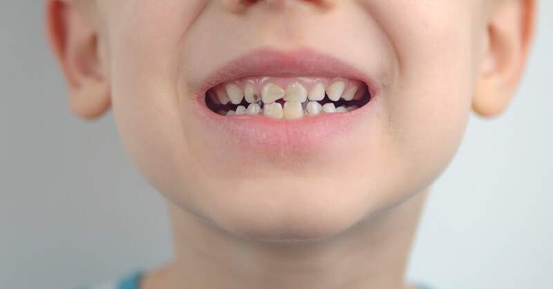 Wie bekommt man gelbe Zähne bei Kindern weg?