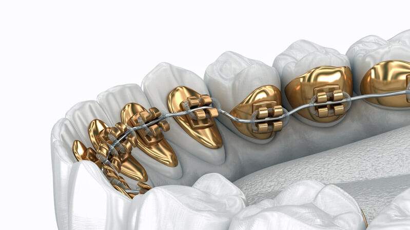 Linguales Zahnspangensystem. 3D-Illustration Konzept der goldenen Zahnspange