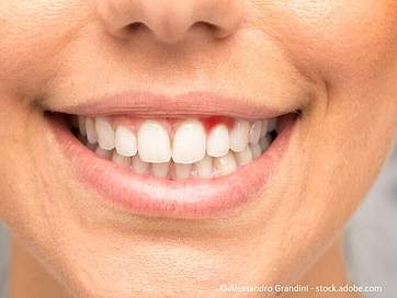 Was hilft bei entzündeten Zahnfleischtaschen? Alles zu Schmerzbehandlung & Reinigung