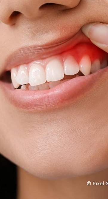 Mundfäule: Was tun bei Entzündungen der Mundschleimhaut?