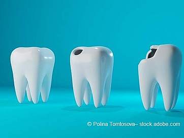 Loch im Zahn groß und klein: Ursachen, Symptome & Behandlung