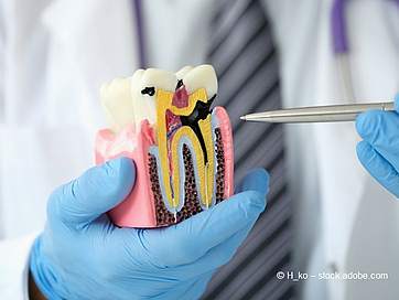 Faule Zähne: Mehr zu Ursachen, Symptomen und Behandlungsmöglichkeiten