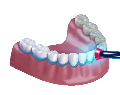 3D-Illustration Gebiss mit Zahnbehandlung Bleaching -Zahnzusatzversicherung Münchener Verein