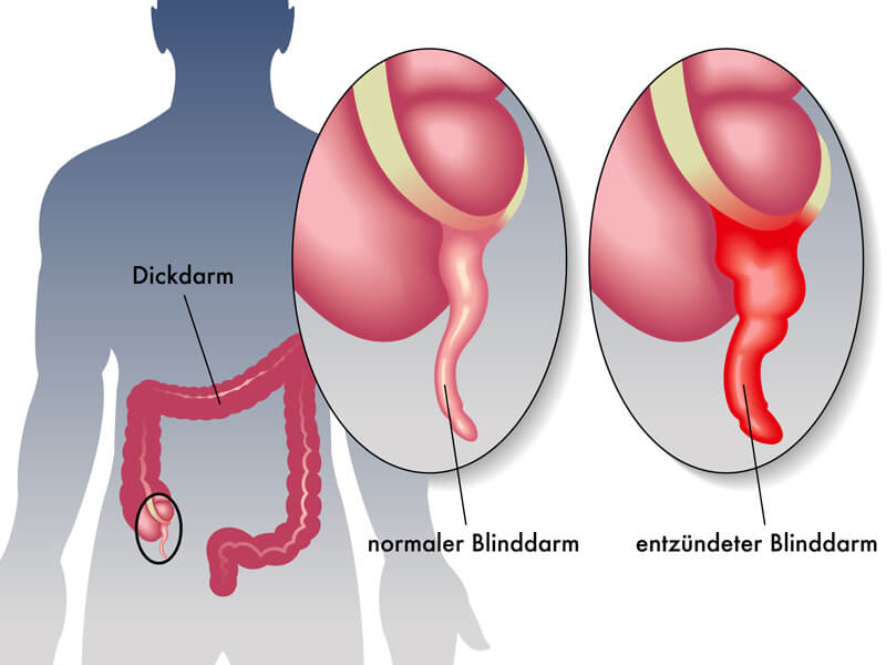 Grafikillustration eines entzündeten Blinddarms