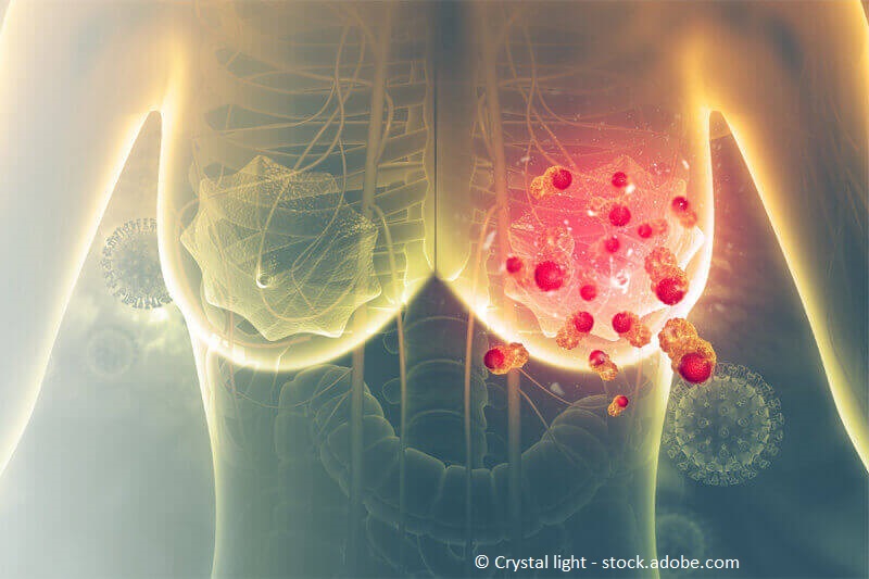 Mammakarzinom – 3D-Illustration: Brustkrebsarten im Überblick