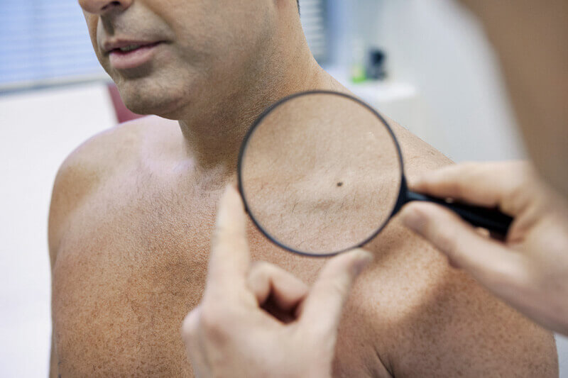 Männlicher Patient unterzieht sich einem Hautkrebs-Screening bei einem Dermatologen