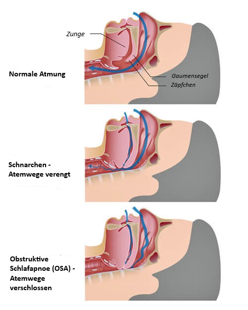 Einfaches Schnarchen oder Schlafapnoe - Ratgeber Gesundheit – Muenchener Verein