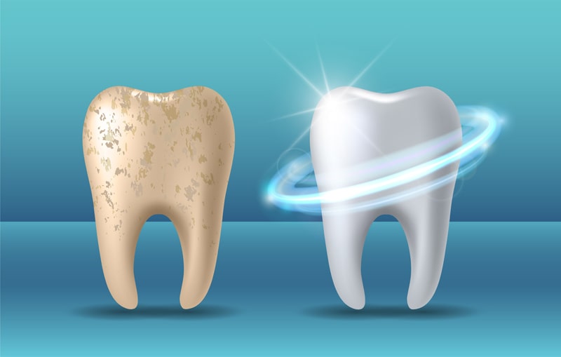 Brüchige und rissige Strukturen können einen abgebrochenen Zahn begünstigen.