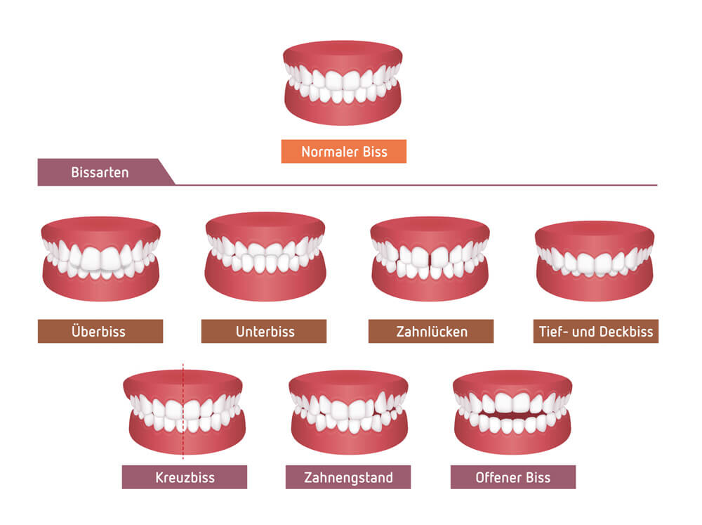 Bissarten - die häufigsten Zahnfehlstellungen -Ratgeber Zahngesundheit - Münchener Verein