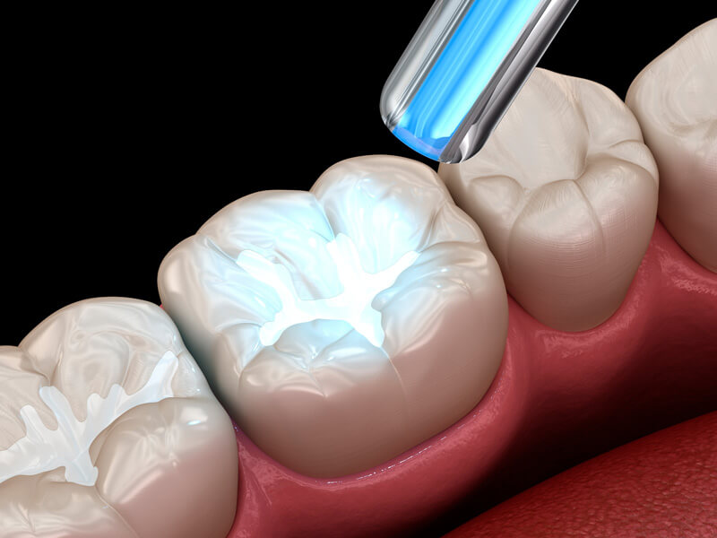 Nach dem Einbringen wird der Kunststoff mit kurzwelligem Licht ausgehärtet - Ratgeber Zahngesundheit - Münchener Verein