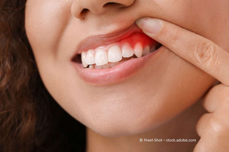 Mundfäule: Was tun bei Entzündungen der Mundschleimhaut?