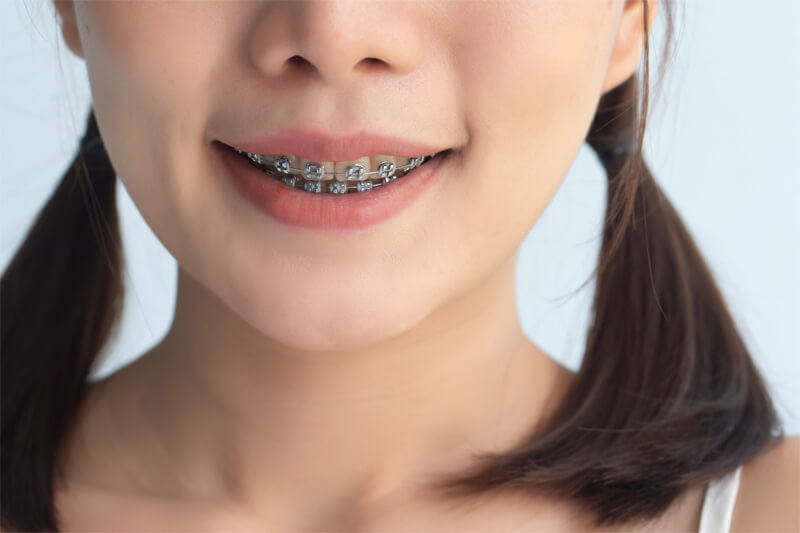 Lächelndes Mädchen mit Zöpfen mit einer kieferorthopädischen Zahnspange.