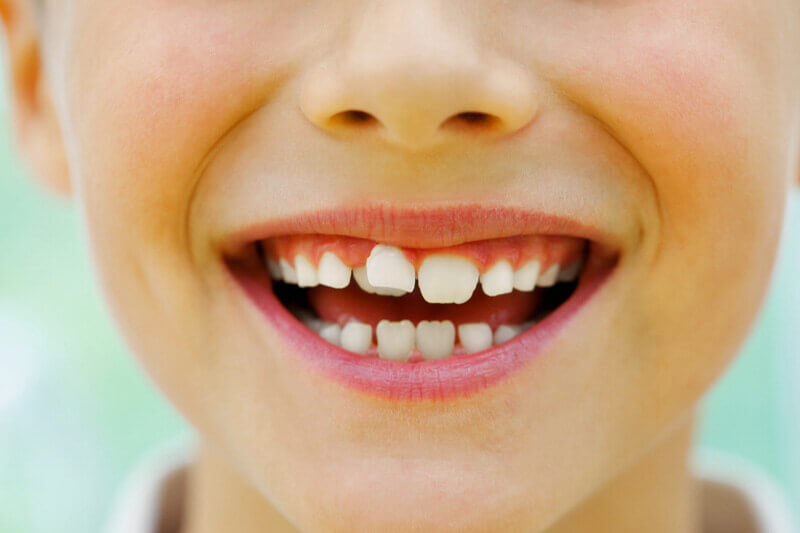 Nahaufnahme von einem lachenden Kindermund mit einer Zahnlücke.