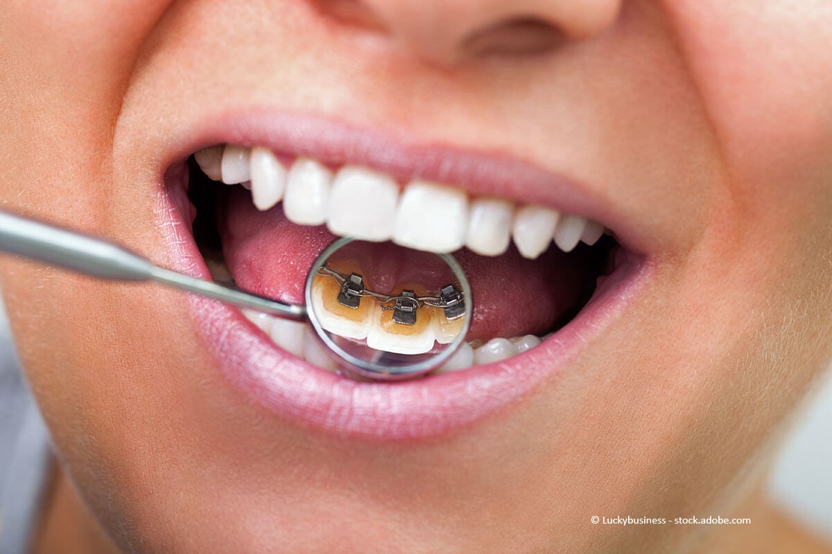 Unsichtbare Lingualspange die über einen Zahnarztspiegel gezeigt wird.