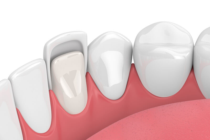 3d-Rendering von Zähnen mit Veneer