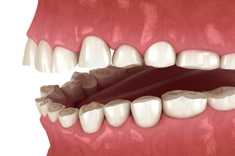 Zähneknirschen (Bruxismus) kann zum Verlust von Zahngewebe führen.