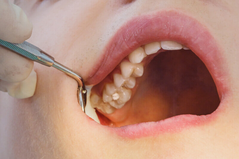 Zahnbehandlung in der Schwangerschaft - Nahaufnahme eines kariösen Zahns
