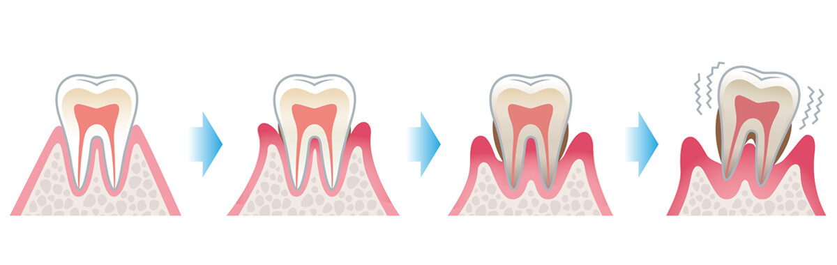 Zahnbelag als Auslöser einer Parodontitis – Verlauf als 3D Animation