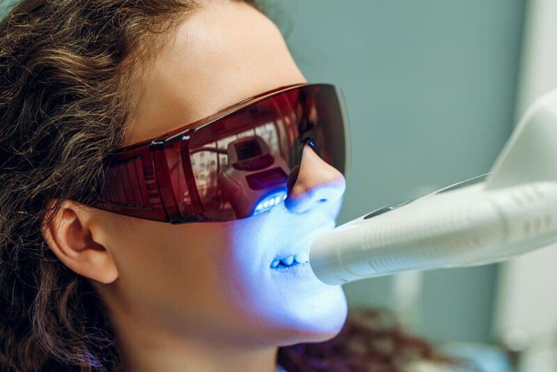 Laser-Bleaching der Zähne in der Zahnarztpraxis