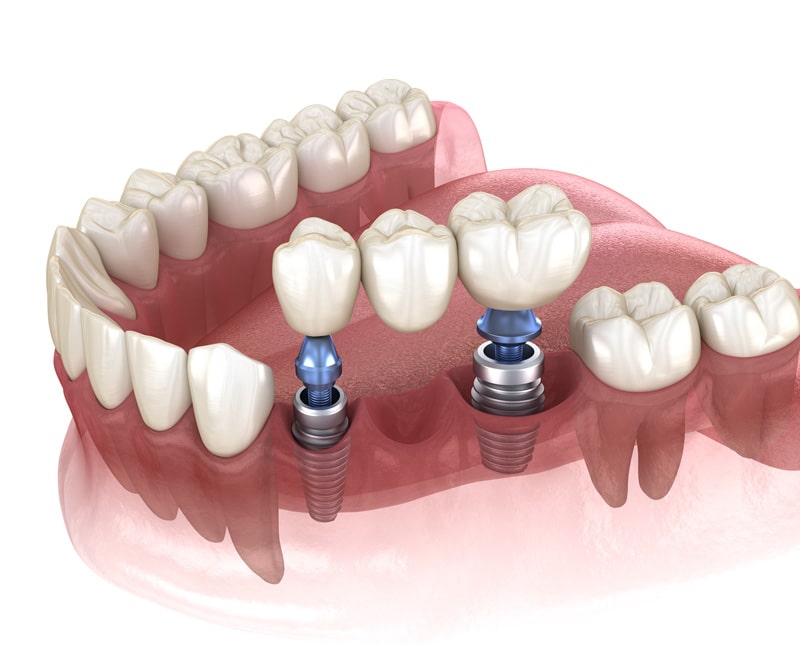 Bei der Implantat-Brücke wird die Zahnbrücke auf sogenannten Brückenpfeilern angebracht.