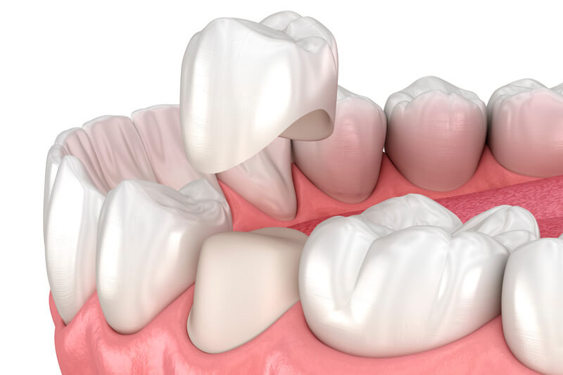Bei einer Krone wird der Zahnersatz fest mit dem noch vorhandenen Zahn verklebt