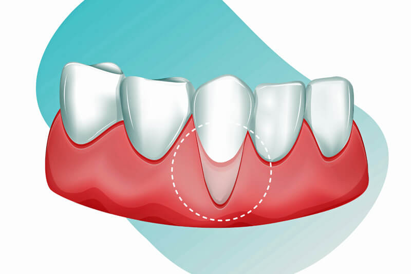 Parodontose ist häufigste Ursache für Zahnfleischschwund - Ratgeber Zahngesundheit - Münchener Verein