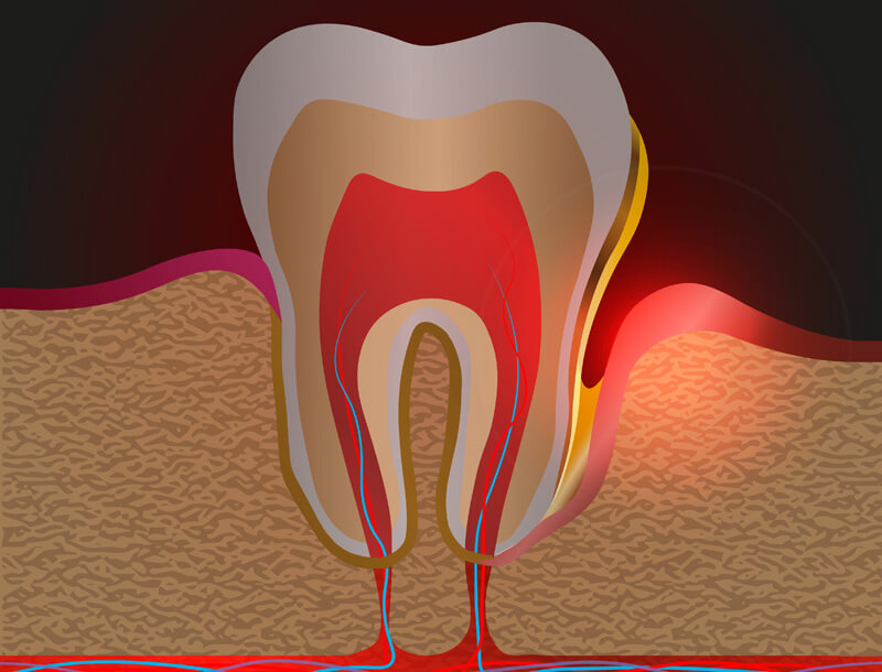 Vergrößerte Zahnfleischtaschen können Entzündungen hervorrufen- Ratgeber Zahngesundheit - Münchener Verein