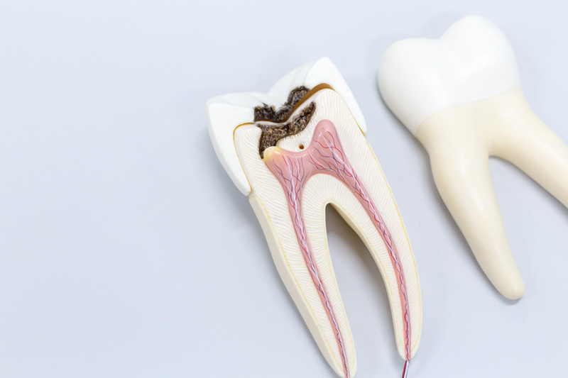 Auch sogenannte „tote Zähne“ können durch Zahnkronen ersetzt werden.