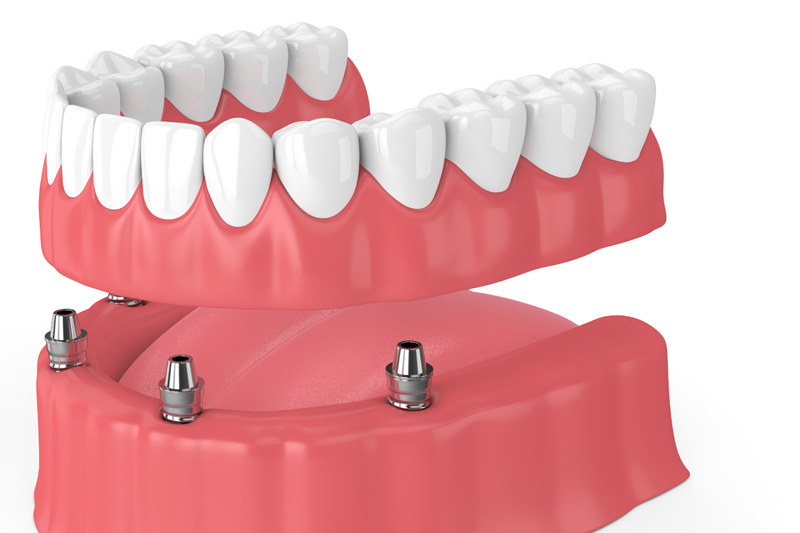 Herausnehmbare implantatgetragene Zahnprothese - Ratgeber Prothesen - Münchener Verein