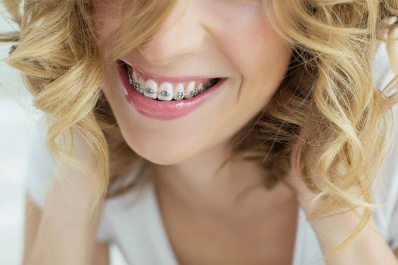 Zahnspange für Erwachsene-Nahaufnahme von einer jungen Frau mit blonden Haaren und fester Zahnspange.